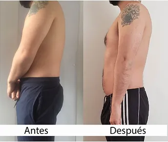 Caso clínico-Hernia discal.jpg.webp