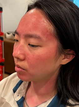 Sunburn_ Left.HEIC