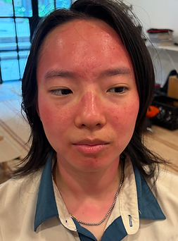 Sunburn_ Front.HEIC