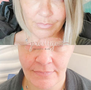 Dermal Filler