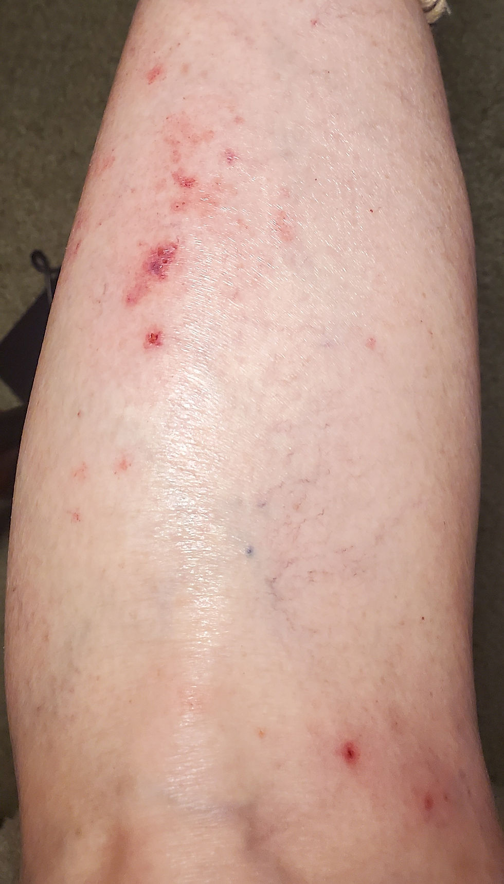 Close-up of a pale skin area with multiple red blemishes and marks, indicating irritation or rash. Neutral lighting, no text.