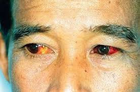 Conjunctival Suffusion and Jaundice (79- Leptospirosis)