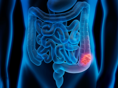 The Latest in Colon Cancer Research: Why We Are Seeing it in Younger Individuals
