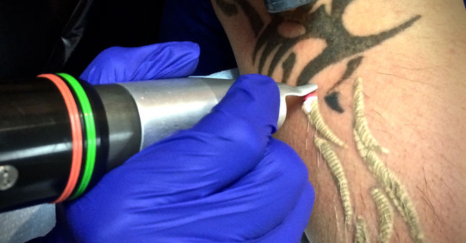 NY STATE LASER REGULATIONS