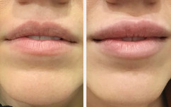 Lip enhancement with Vobella