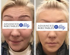 Forehead lines treated with Botox