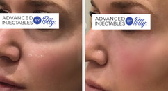 Tear troughs treated with Vobella