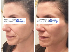 Tear troughs treated with Vobella | Cheeks & chin enhanced with Voluma