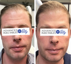 Forehead lines treated with Botox
