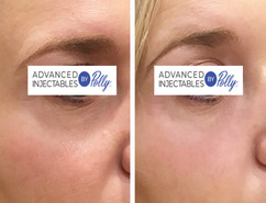 Tear troughs treated with Vobella