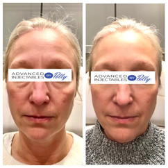 Forehead & frown lines treated with Botox