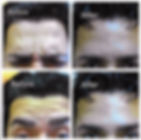 Botox