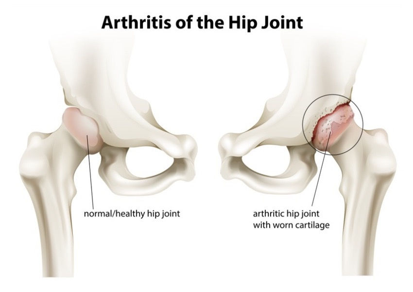 osteoarthritis of the hip