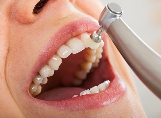 تلميع وتنظيف الأسنان بشكل احترافي في دبي