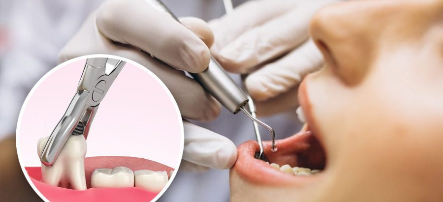 خلع الأسنان في دبي: خدمات سريعة وموثوقة