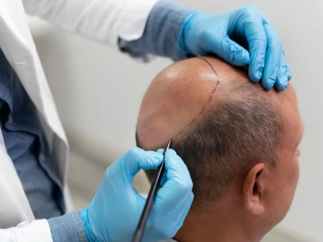 How Do You Know If a Crown Hair Transplant Is Needed?