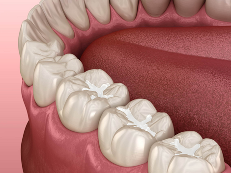 How Does Age Affect the Need for Dental Filling?