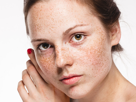 Understanding the Different Types of Birthmarks and Their Treatments