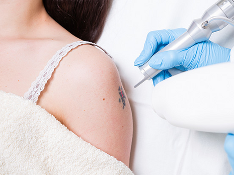 Can Laser Tattoo Removal Remove Permanent Makeup?