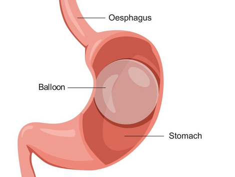 Gastric Balloon Placement: Understanding the Procedure