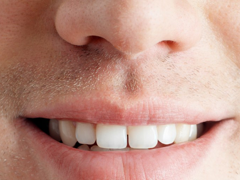علاج شامل للأسنان المتداخلة متاح
