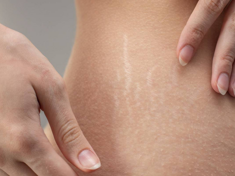 Understanding Laser Stretch Mark Removal: What to Expect 