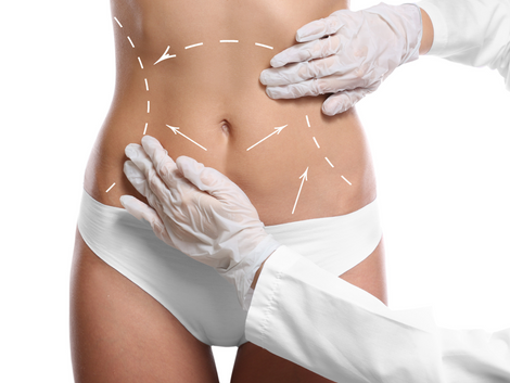 What Are the Long-Term Effects of Laser Liposuction?