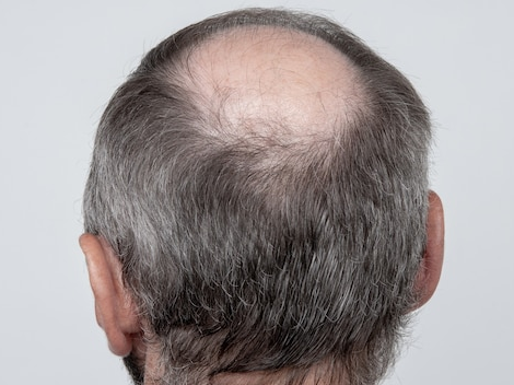 Exploring the Benefits of Crown Hair Transplants