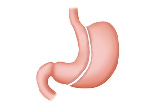 Tips for a Smooth Gastric Sleeve Surgery Journey: