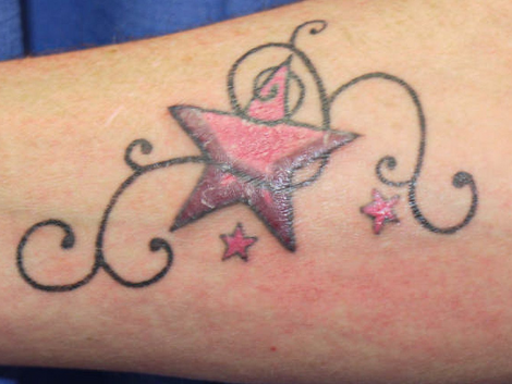 The Ultimate Guide to Infection Prevention After Laser Tattoo Removal