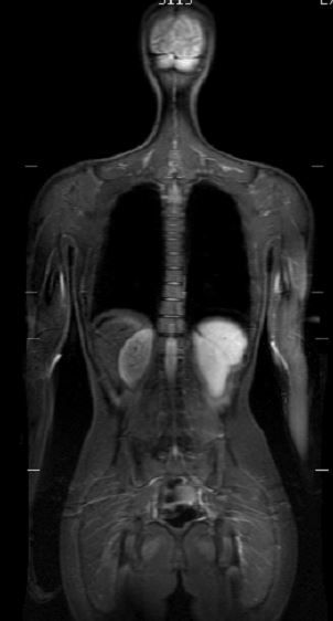 Full body MRI images including brain scan, brain MRA, Neck & Carotid scan, and abdomen scan. 