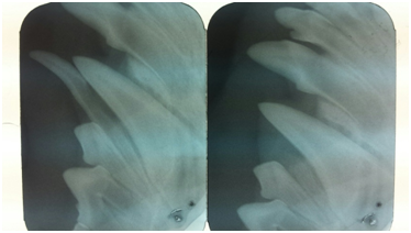 An x-ray before and after the extraction of a baby tooth