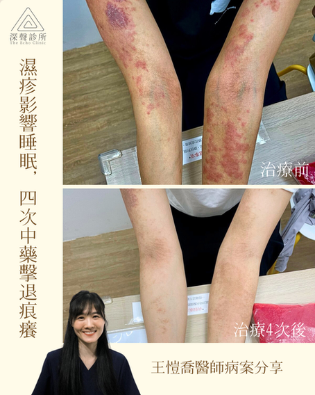 濕疹影響睡眠,四次中藥擊退痕癢 (By王愷喬醫師)