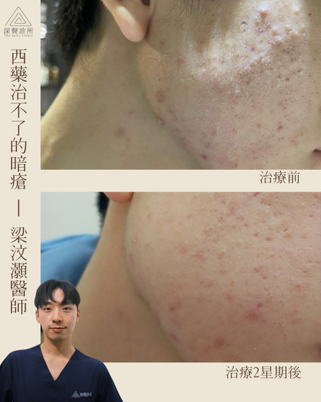中六男生 西藥治不了的暗瘡 (By梁汶灝醫師)