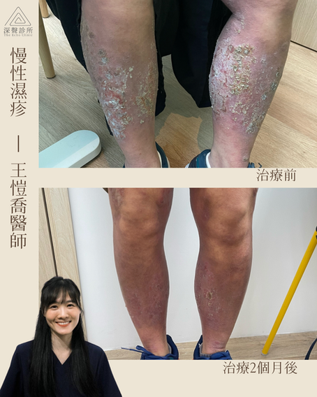 35歲女士 慢性濕疹 (By王愷喬醫師)