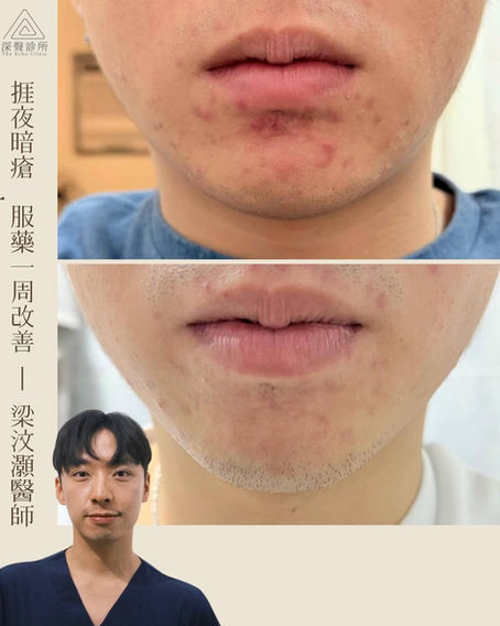 23歲男 捱夜暗瘡, 服藥一周改善 (By 梁汶灝醫師)