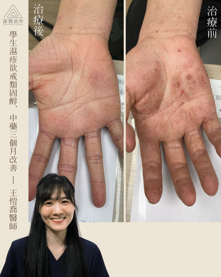 學生濕疹欲戒類固醇，中藥3個月改善 （By王愷喬醫師）