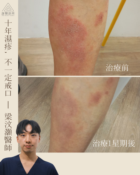 67歲男 十年濕疹, 不一定戒口 (By 梁汶灝醫師)