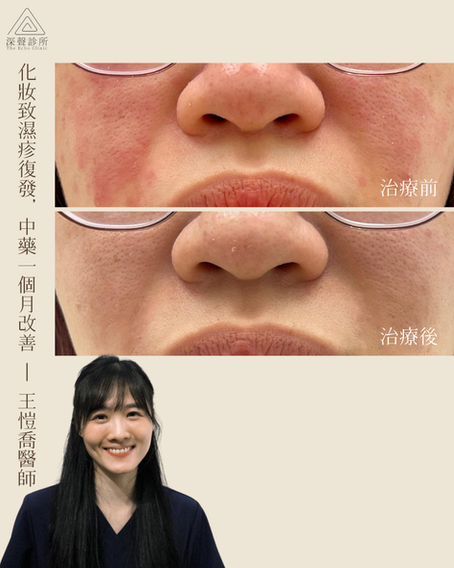 化妝致濕疹復發,中藥一個月改 (By王愷喬醫師)