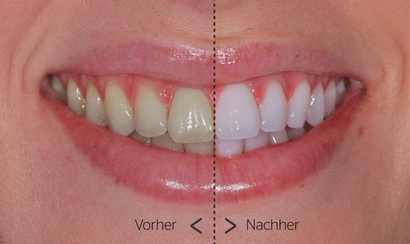 Voher-Nacher