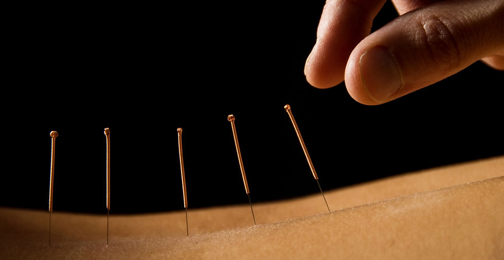 Acupuncture Dry-needling kinésithérapie Paris 6 Cabinet Lekain