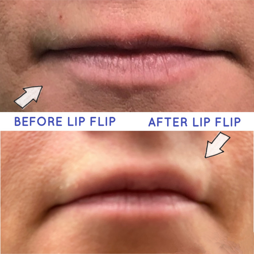  botox dysport jeuveau or xeomin lip flip