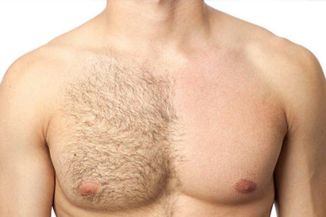 body-hair-transplant.jpg