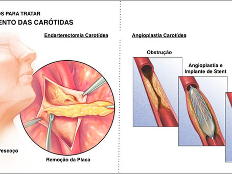 Doença Carotídea