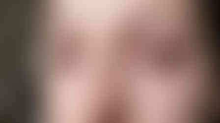 Close up of eyes irritated by allergies