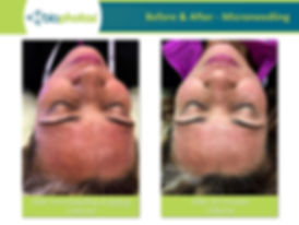 CELLUMA AFTER MICRONEEDLING2.jpeg