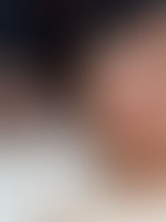 Cold Plasma Treatment