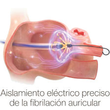Innovador sistema de mapeo y ablación por campo pulsado