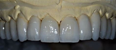 Thumbnail: Dental Implants