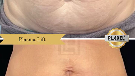 What is Plasma Fibroblast Therpay?